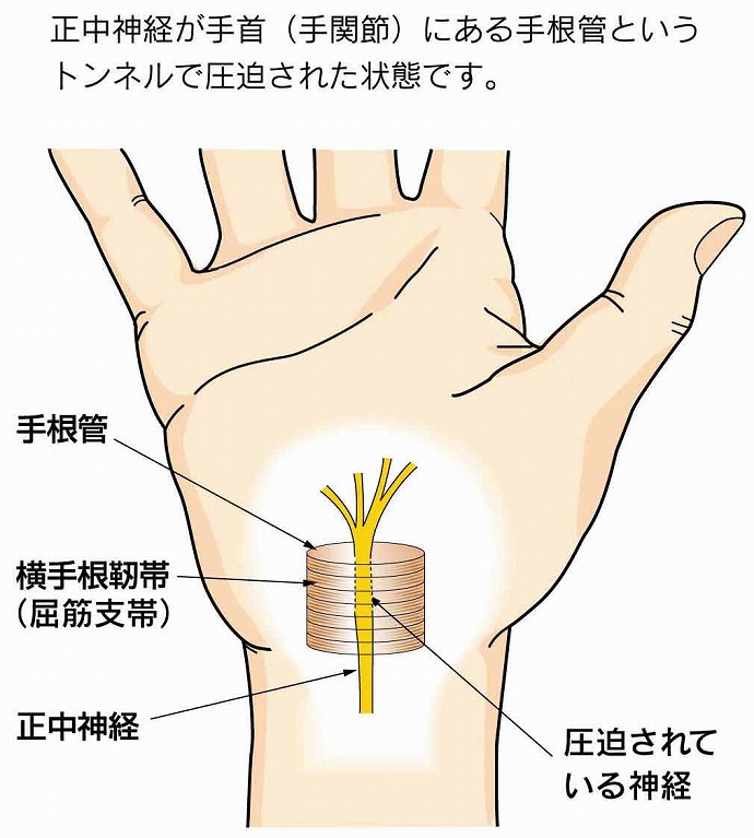 手根管症候群とは